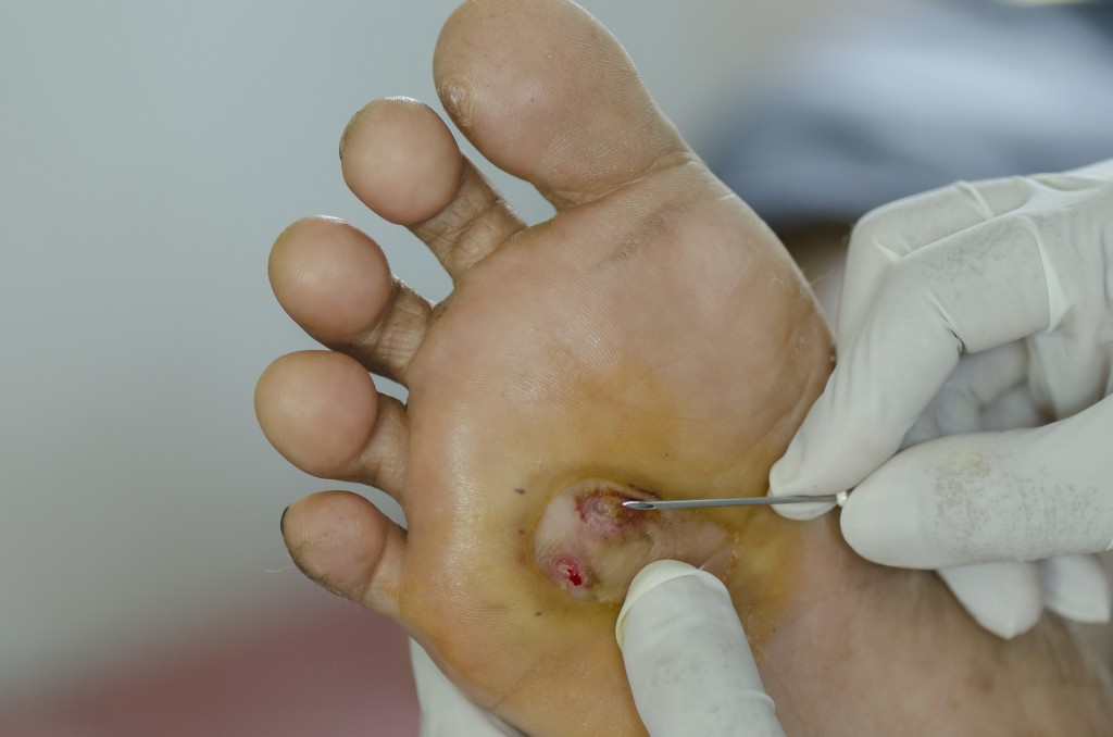 Na diabetických nohou se často utváří mimo jiné i boláky a puchýře