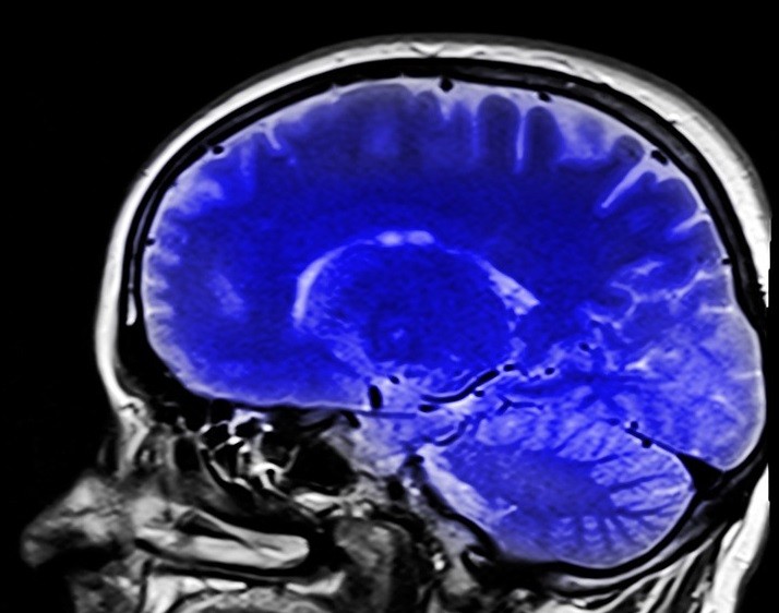 Nemoc způsobuje odumírání mozkových buněk produkujících neuropřenašeč dopamin