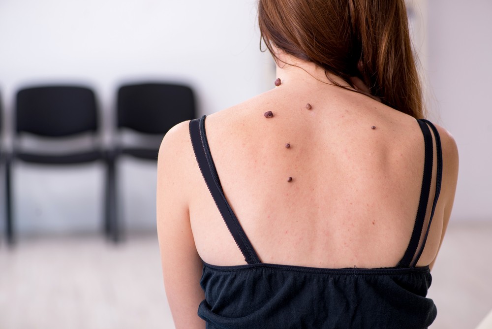 Bradavice jsou nezhoubné nádorky (novotvary) způsobené lidským kožním papilomavirem HPV