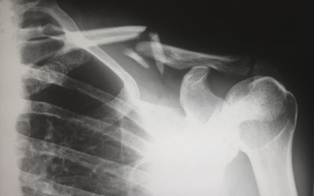 Vznik osteoporózy mohou způsobit i poruchy příjmu potravy
