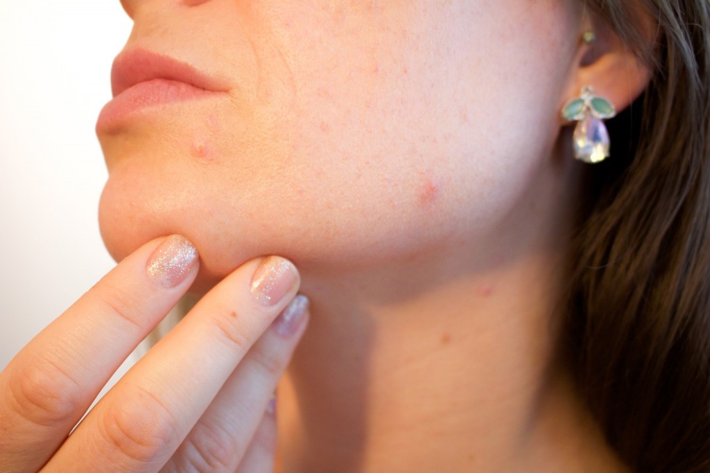 Vhodnou prevencí, jak předcházet výskytu akné, je i úprava jídelníčku
