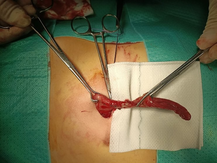 Foto: Operace apendixu