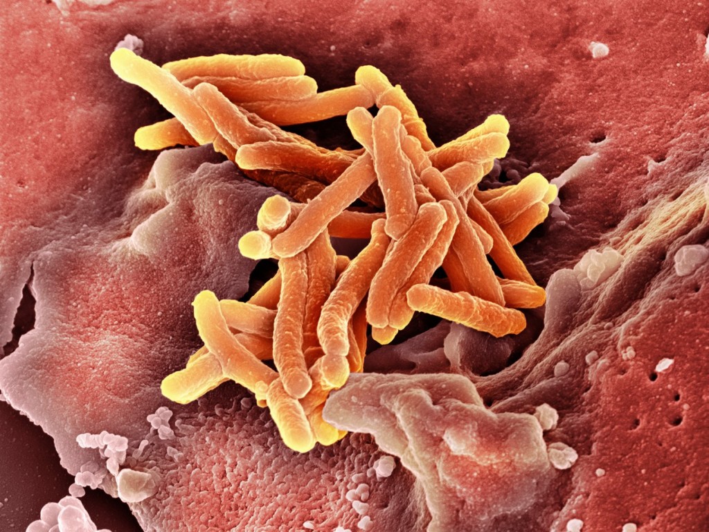 Tuberkulóza většinou napadá plíce, ale může postihnout i jiné části těla. Šíří se vzduchem