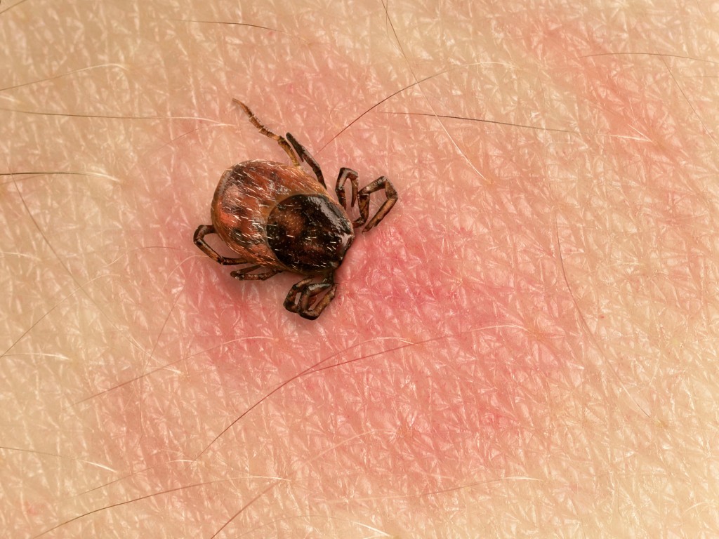 Ideální je podle lékařky použít k odstranění klíštěte sterilizovanou pinzetu