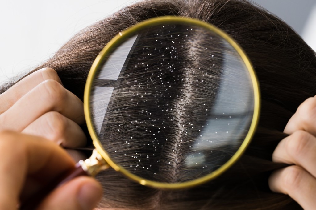 Nejčastější příčina lupů je seboroická dermatitida