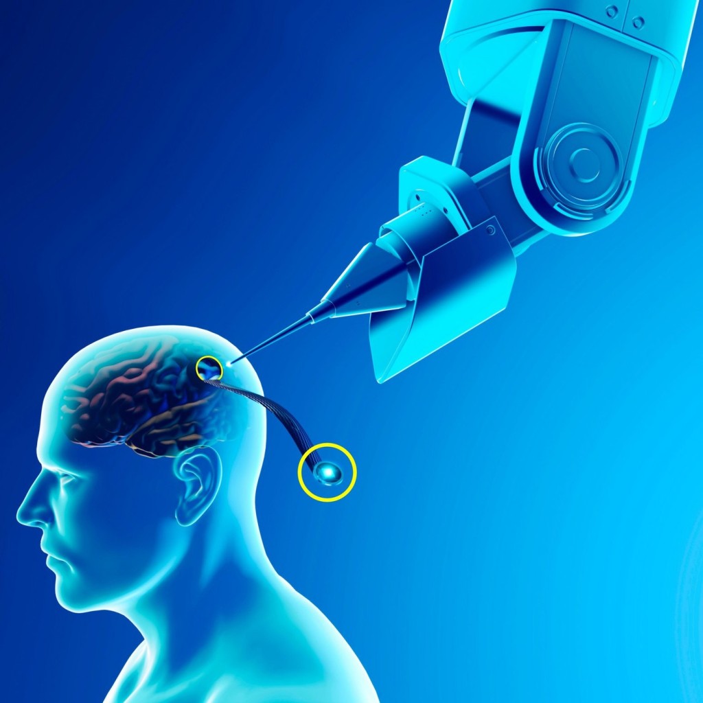 Prvotním cílem implantace čipu do mozku člověka je, aby byli lidé bez končetin schopni ovládat počítače