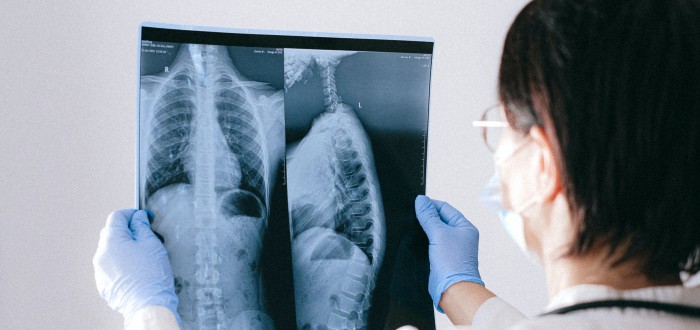 Dušnost a kašel je společným jmenovatelem příznaků plicních fibróz