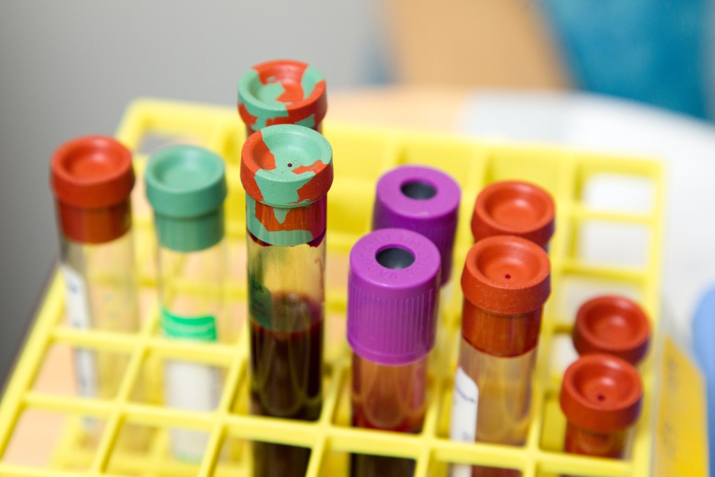 Každodenní konzumace kyseliny listové vede ke zvýšenému riziku rakoviny prostaty