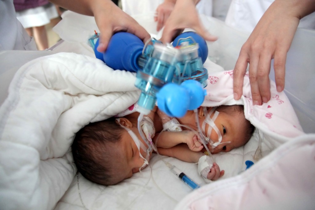 Abby a Brittany Hensel neměly přežít ani první noc, nakonec mají dva vysokoškolské tituly
